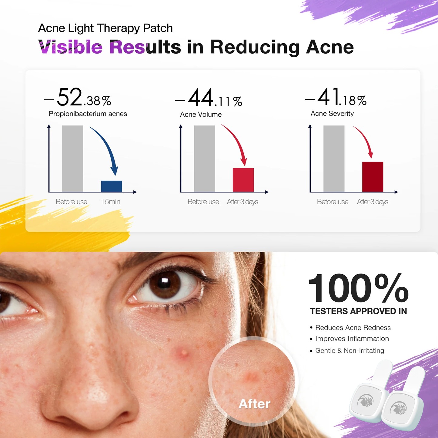 LED Acne Therapy Patch, with Red & Blue Light Therapy – Best Pimple Patch for Acne Treatment, Anti-Acne Spot Corrector, Rechargeable LED Skincare Device, Free Hydrocolloid Acne Patch and Stickers